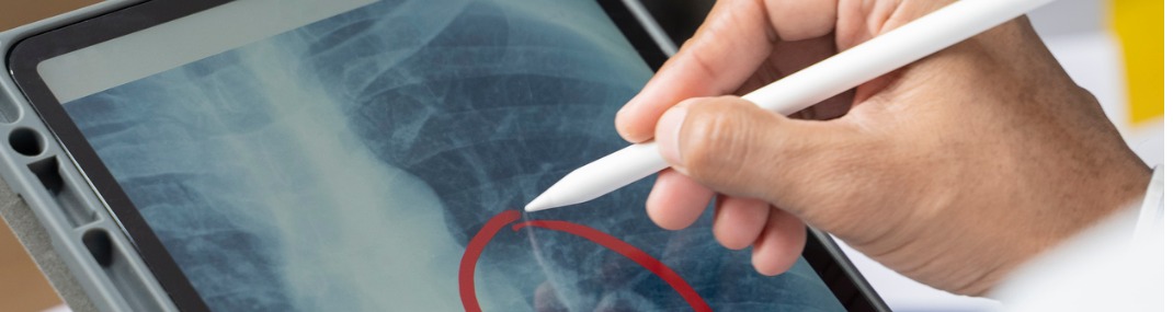 Pulmonary Nodules Hero