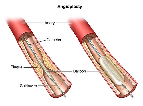 angioplasty image