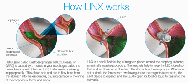 Linx Acid Reflux Management